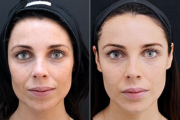 The Benefits of Microneedling Before and After 1 Treatment