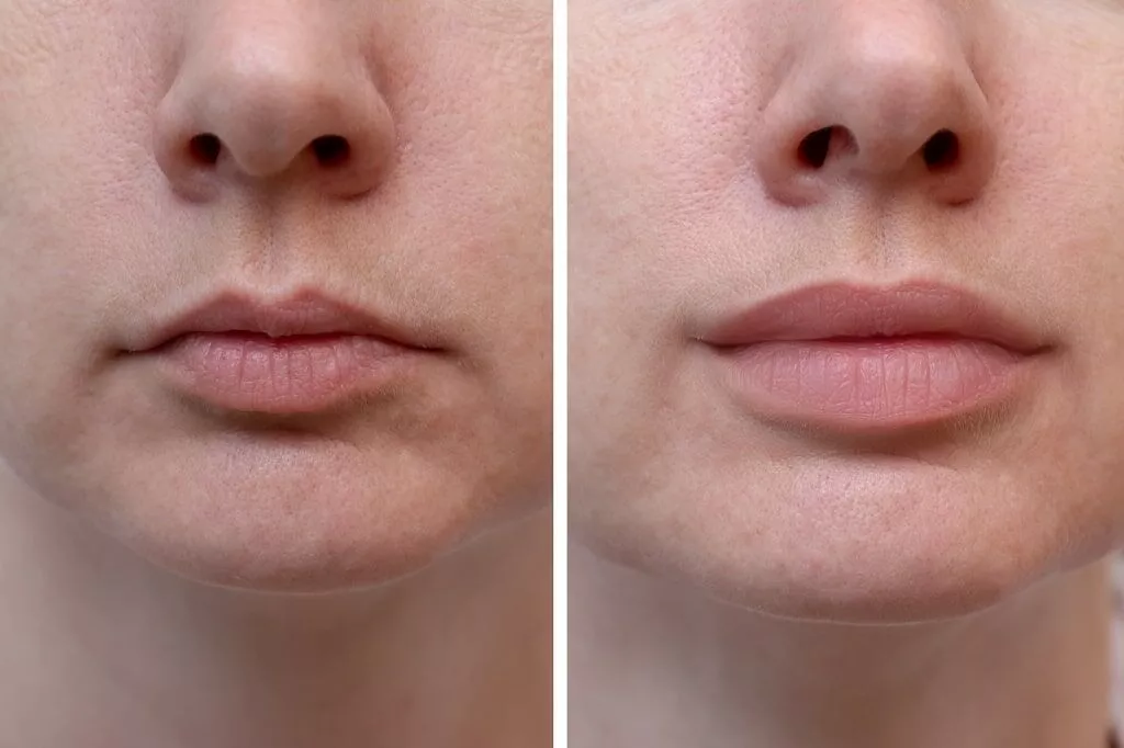 How Much Do Lip Fillers Cost?